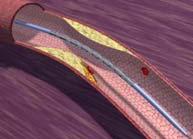 Stent Insertion Plaque Rupture 46 Did The Problem Go Away? After 5-7 years, 30-50% of vessels used to bypass blocked arteries are now blocked. After 4-6 months, 30-50% of ballooned arteries re-close.