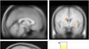 with reduced connectivity (measured with diffusion-weighted MRI) in cannabis users (n=9) than in controls (N=33) Zalesky et al Brain DA Synthesis Capacity in Cannabis Abusers