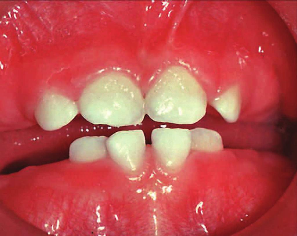 PLAQUE Cavity-causing bacteria live in plaque. Plaque is a soft, yellow-white, sticky material found on teeth and gums. Plaque irritates the gums and causes tooth decay.