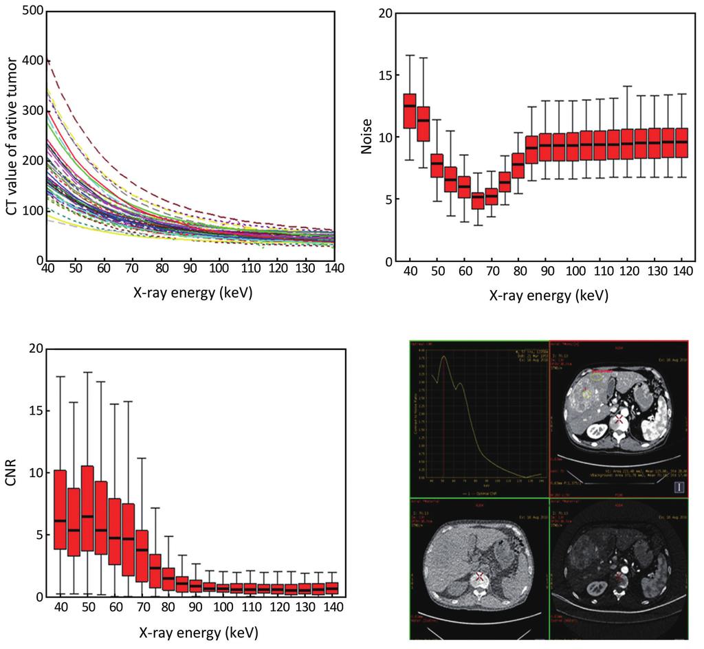 440 Gao et al. Fused monochromatic spectral CT imaging for HCC A B C D Figure 1 Different types of monochromatic imaging acquired by single source dual energy CT (ssdect).