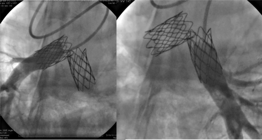 86 Circ Cardiovasc Interv February 2011 Figure 8. Bilateral branch pulmonary arteriograms taken 6 weeks after Melody valve implantation into the right and left branch PAs, respectively.