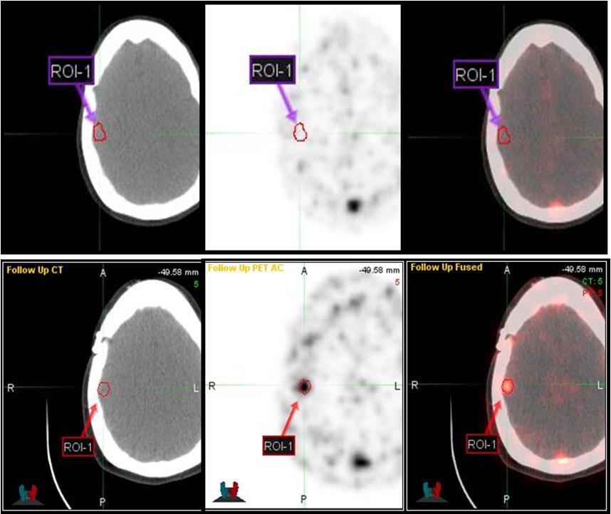 MM-302 SABCS 2013 Phase 1 Data CT PET merge Anthracycline Naïve Response Data 44 hr 53 min ROI ROI ROI=RegionofInterest ROI ROI ROI ROI Positron emission tomography/computed tomography (PET/CT) of