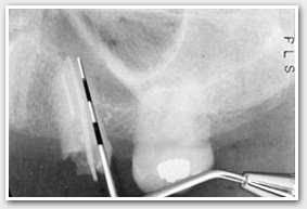 The longer a dowel, the greater its retention. Post descend as far down the root canal as possible in order to provide as much retention as possible to the post and core system.