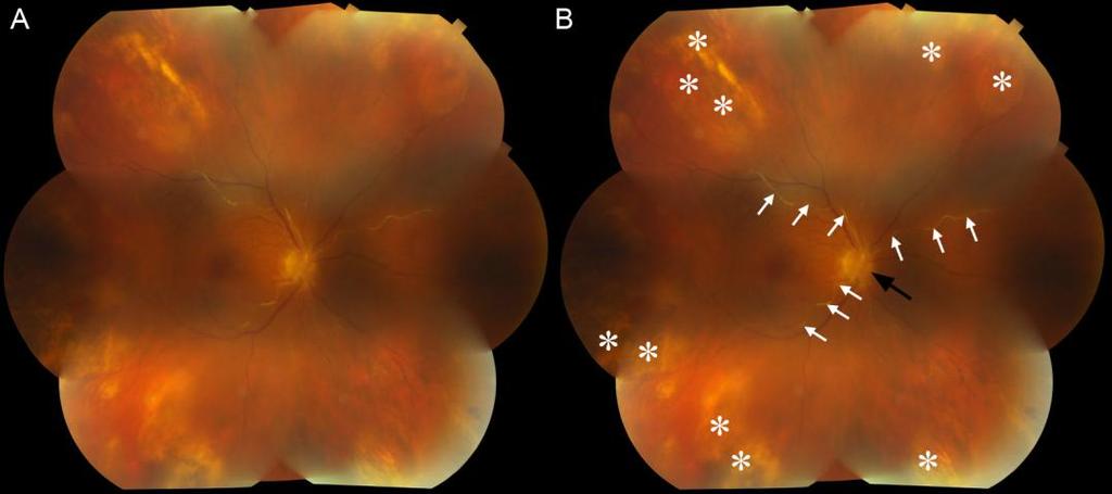 Figure 2. (A) After treatment with anti-viral medication, there is regression of retinal whitening and atrophic retinal tissue. (B) Areas of regression are indicated by white asterisks.