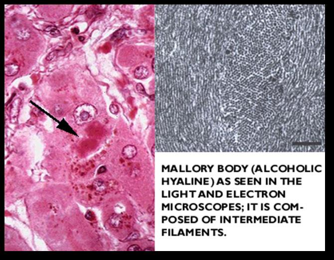 Mallory alcoholic bodies: liver cytoplasmic aggregates of fragmented fine