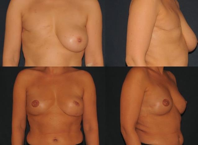 Lipomodelling: for total breast reconstruction