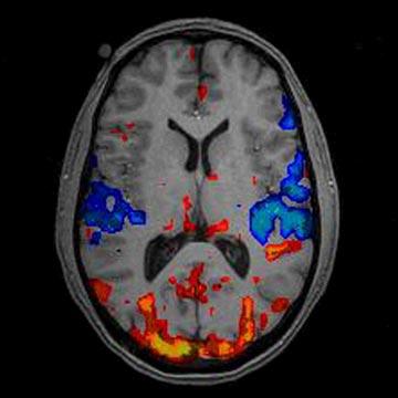 Getting Closer to a Solution Recent study combined a novel visual stimulus with recent developments in the analysis of functional magnetic resonance imaging (fmri) data to show