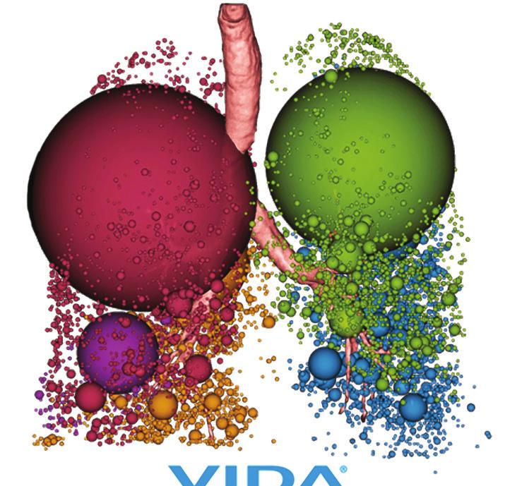 by SeleCT by VIDA provides clinicians a method to submit High Resolution CTs (HRCTs) and receive quantitative measurements to support visual readings of lung parenchyma that may be suitable for