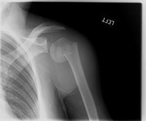 Humerus Fracture Humerus bones thick less likely to break Mid shaft fractures are