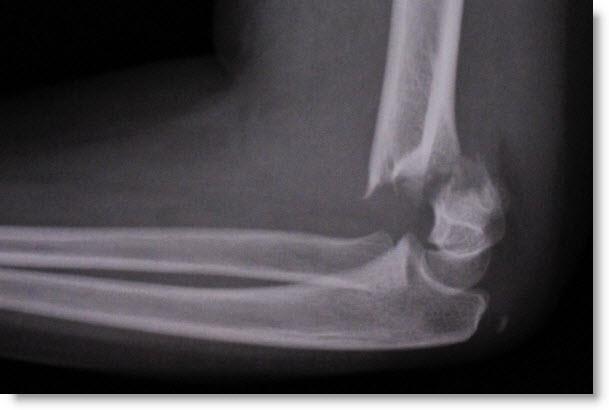 ELBOW 10% of all fractures in children Most are