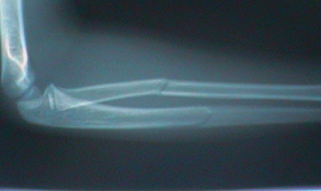 Radius/Ulna Fracture Childhood forearm fractures very common following a fall