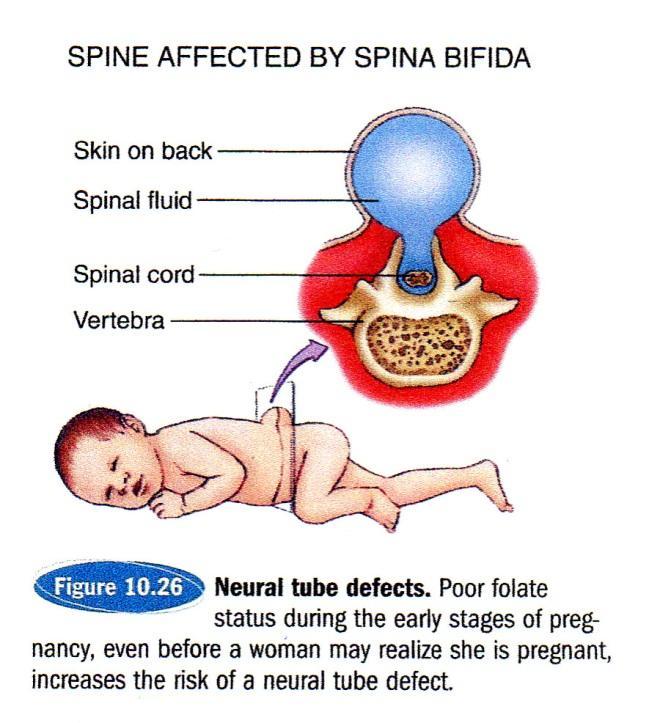 COMPLICATIONS Pregnancy women: Neural Tube Defect (NTD), prematurity of