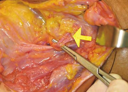 auricular nerve (yellow arrow) Figure 5-6