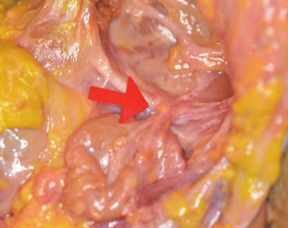 nerve (CNXI) identified 1 cm posterior