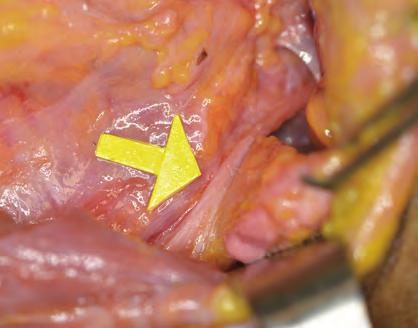 (yellow arrow) and transverse cervical vessel