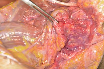 lymphatic dissected free from accessory nerve