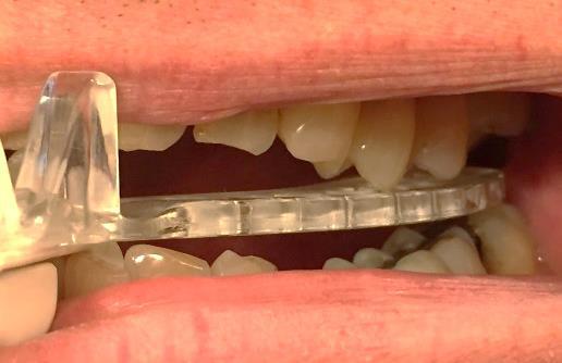 Covering some portion of last tooth ensures adequate (3.