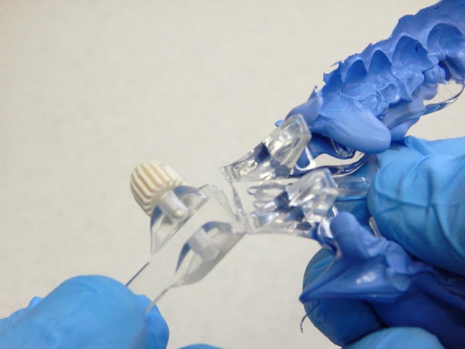 Trimming excess material facilitates unobstructed direct line of sight from the camera to teeth thereby achieving fast occlusion scanning and reduced reading errors.