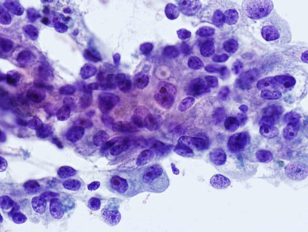 Rib, left, 6 th, CT-guided FNA: Papanicolaou stain, 40x Presentation material is
