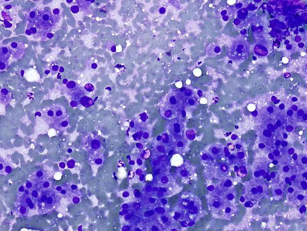 Liver, ultrasound-guided FNA: Diff-Quik stain, 20x Presentation material is for