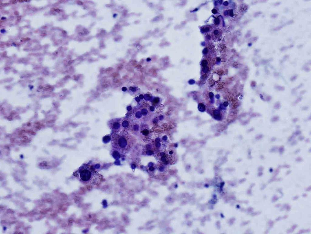 Liver, ultrasound-guided FNA: Papanicolaou stain, 20x Presentation material is