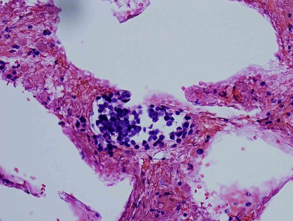 Liver, ultrasound-guided FNA, Cell Block, H & E stain, 20x Presentation material is