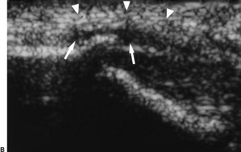 MILLER ET AL bony attachment with associated outward bowing of the tendon in our series, described by Maffulli et al as radial head bursitis, 8 did not correspond to radial head bursitis on our MRI
