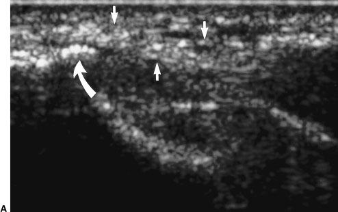 Similarly, radial head bursitis was not present on MRI in any of the 24 cases reported by Martin and Schweitzer 6 or on sonography for any of the cases reported by Connell et al.