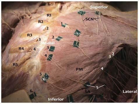 Woodworth et al Regional Anesthesia and Pain Medicine Volume 42, Number 5, September-October 2017 FIGURE 4. Photograph of anterior body wall nerves.