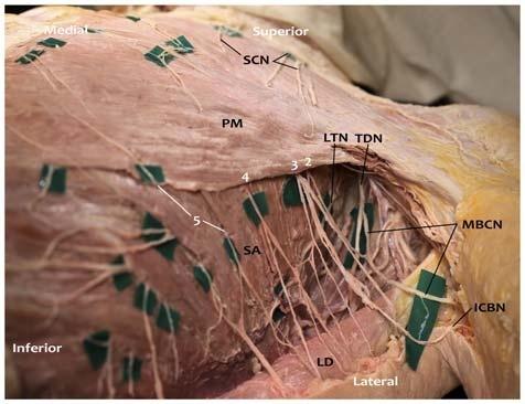 Anterior cutaneous branches (black numbers) of the intercostal nerves emerge from the intercostal spaces and travel inferolaterally before piercing the PM muscle.