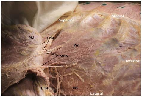 The LPN is depicted arising from the lateral cord of the brachial plexus and innervates the PM. The MPN is shown arising from the medial cord.