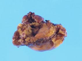Case Reports in Otolaryngology 3 Figure 4: The 20 mm 10 mm tumor. The smooth surface of the removed tumor is light brown in color with a solid appearance.