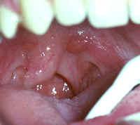 Accessory tonsils may be noted at the posterior part of the soft palate, often near the base of the uvula (Figure 2.32). They may resemble a small tumor.