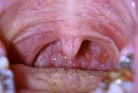 More tonsillar tissue can be noted by depressing the tongue down and having the patient say "ah".
