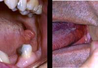 Figure 2.40. Two different patients with enlarged, reactive foliate papillae. Figure 2.41. Two different patients with enlarged pseudocysts in the foliate papillae on the right side of the tongue.