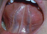 Normal ventral surface of the tongue showing the midline lingual frenum, and the two prominent lingual veins running on each side.