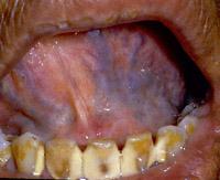 These are dilated veins due to loss of elasticity and do not reflect any systemic condition. Next, have the patient open the mouth and try to touch the hard palate with the tongue.