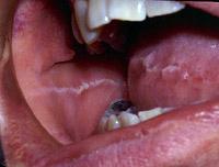 The other landmark on the buccal mucosa is a white line known as the occlusal or bite line, a horizontal line running from the corner of the mouth posteriorly where the teeth meet the mucosa (Figure