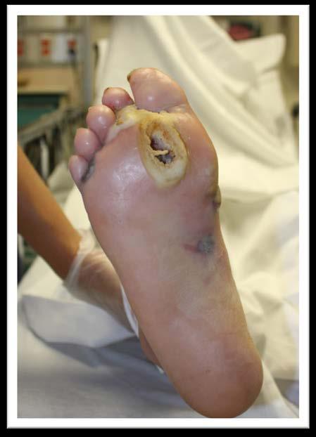 CLINICAL PRESENTATION Ulcers can involve any part of the toes, foot, or ankle Complicated by
