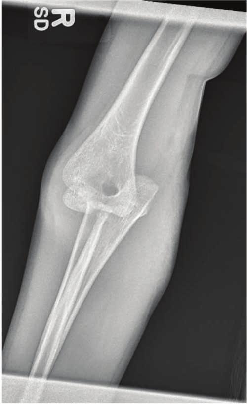 2 Case Reports in Orthopedics Figure 1: AP and attempted lateral radiographs of the right elbow demonstrating anteromedial elbow dislocation in a skeletally immature individual.