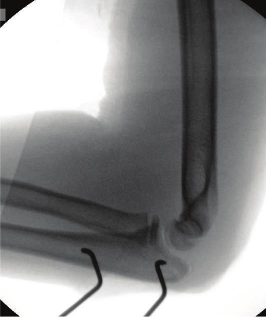 Figure 4: AP and lateral radiographs of the right elbow 7 months postoperatively demonstrating continued anatomic reduction of the ulnohumeral and radiocapitellar joints.