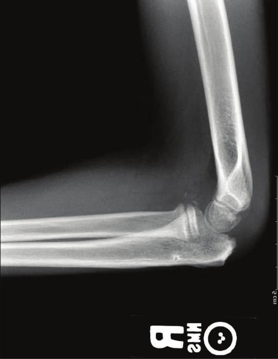 This is not a well-known occurrence, and to the best of our knowledge, only one prior case report of this exists [5]. Relief of this entrapment allowed for easy ulnohumeral joint reduction.