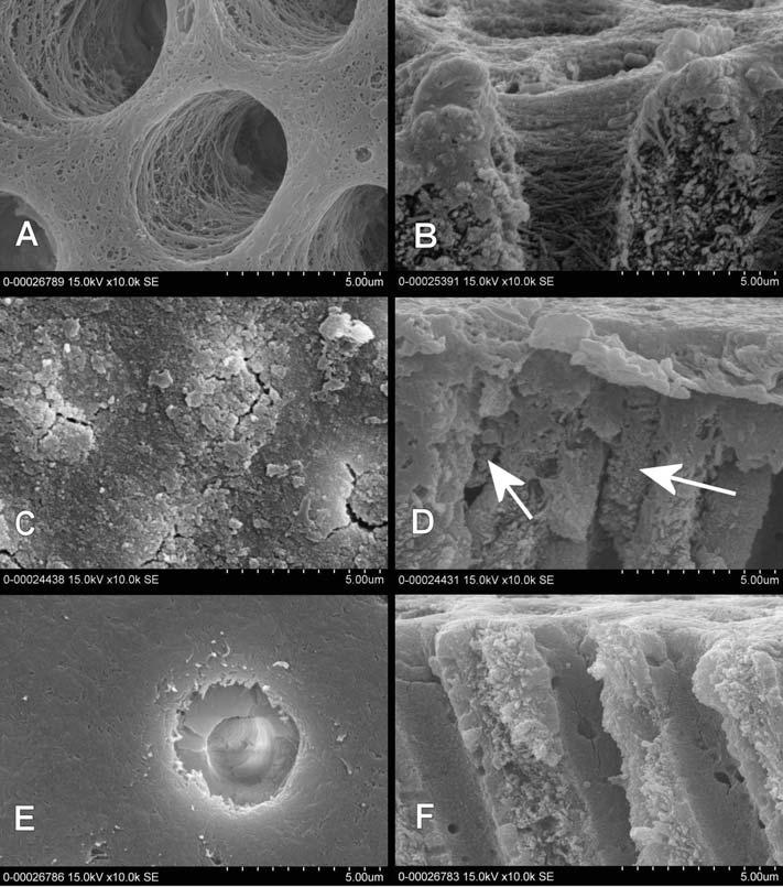 in vitro Figure 5- Representative scanning electron microscopy (SEM) micrographs of dentin surfaces and perpendicularly fractured aspects Free surface and dentinal tubular walls were clean.