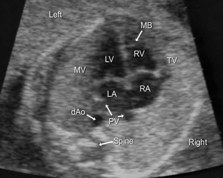 The main features to confirm from the four-chamber view are that: 1) The heart occupies no more than 1/3 of the area of the thorax. 2) The cardiac apex points to the fetal left.