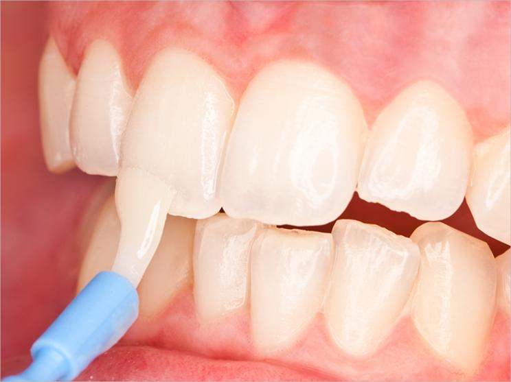 Fluoride Varnish Fluoride is a mineral that helps to prevent tooth decay Fluoride varnish is a gel that is painted onto the teeth to prevent decay It works by strengthening tooth enamel, making it