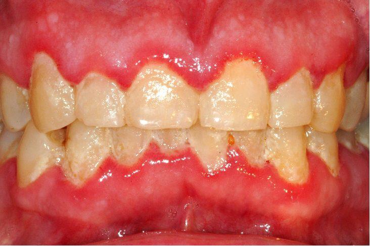 Cause of Dental Disease Many different types of bacteria live in our mouths These bacteria build up on our teeth and along the gum line, forming a sticky colourless film called plaque.