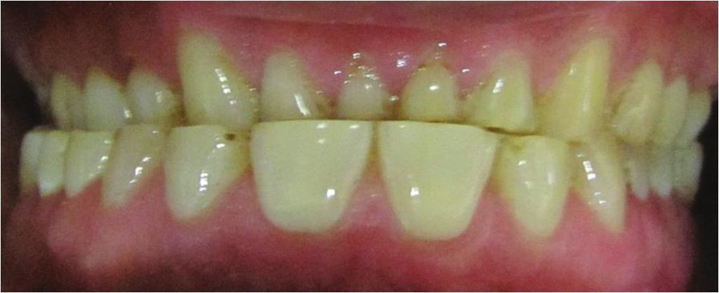 Endodontic and periodontal status was good except for mandibular left and right central and lateral incisors which needed endodontic treatment.