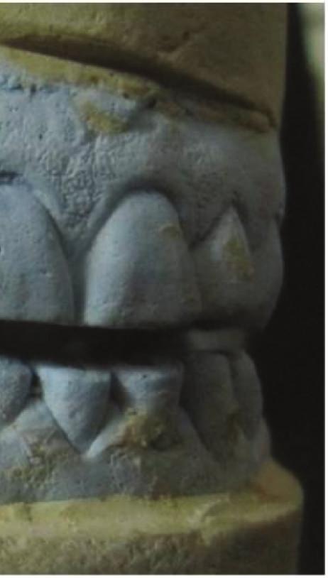 Impressions for study casts were made with irreversible hydrocolloid (Zelgan 2002, Dentsply) material along with a centric relation occlusal record.