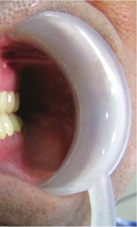 occlusal habit and started grinding his anterior teeth. Once the anterior teeth got shorter, the patient lost anterior guidance and developed posterior interferences.