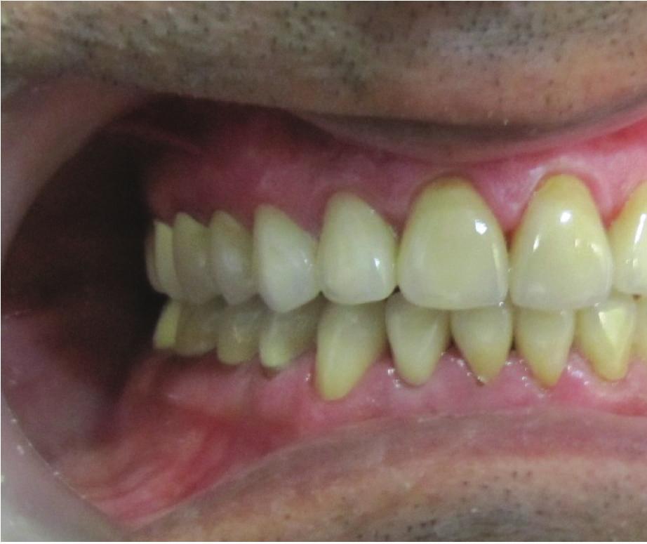 A mutually protected occlusal scheme was used to prevent the destruction of the new prostheses.